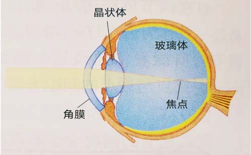 年輕時近視后會得老花眼嗎